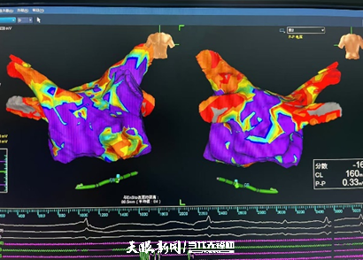 术前基质标测（上）和术后基质标测（下）.png